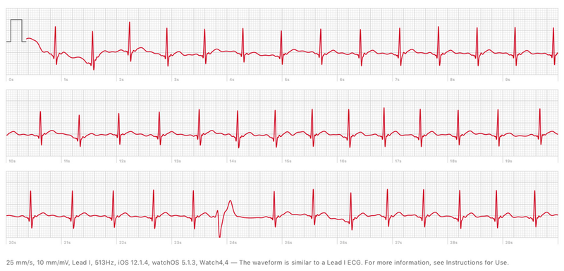 ecg-apple-watch