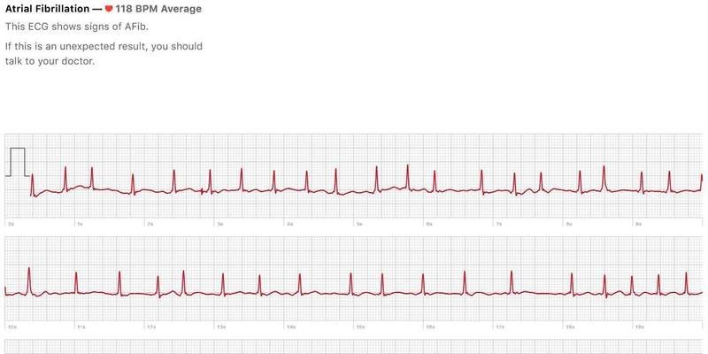 apple-watch-ecg-results